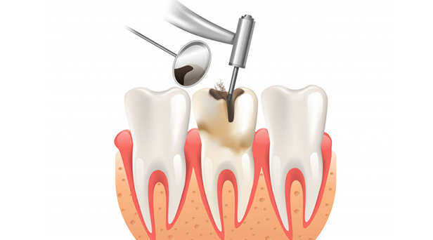What Makes You A Candidate For Root Canals